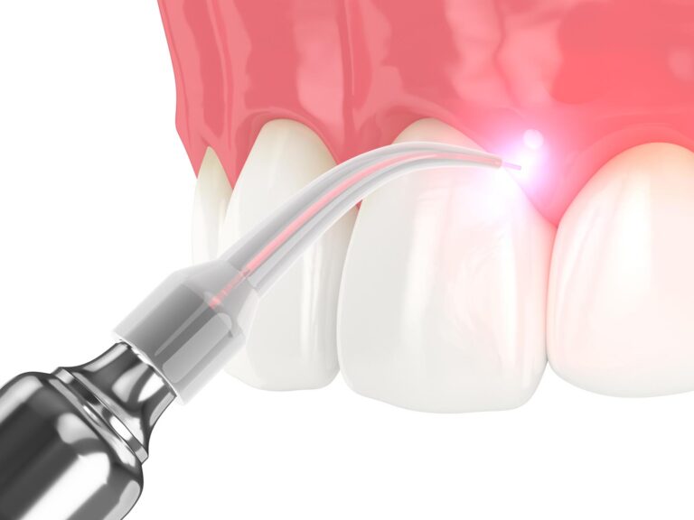 3d render of dental diode laser used to treat gums. The concept of using laser therapy in the treatment of gums.