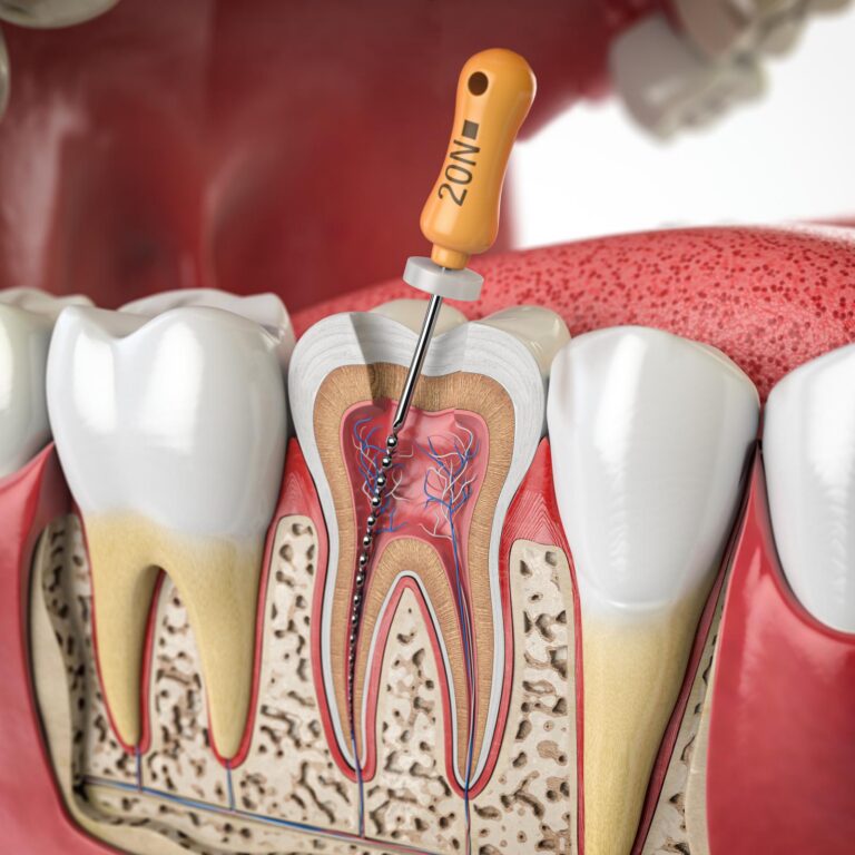 Cross section of human tooth with endodontic rotary file. 3d illustration.